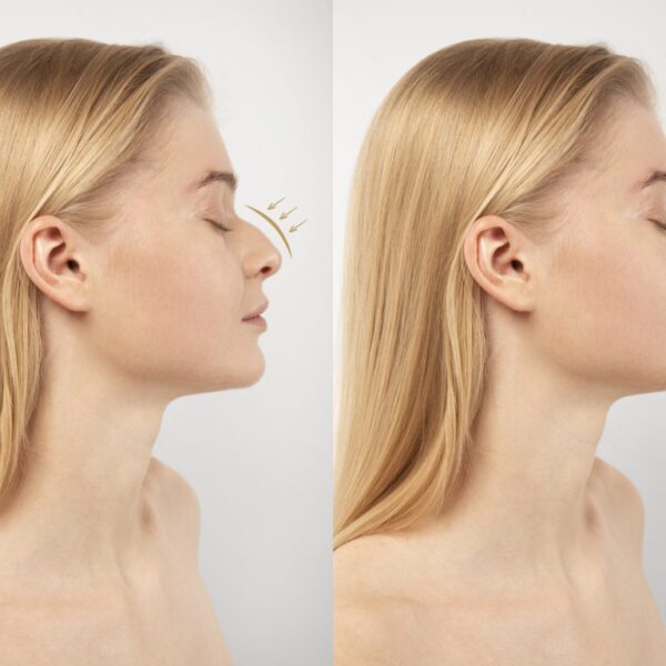 Is a Nose Job in Dubai the Best Choice for Enhancing Your Features?